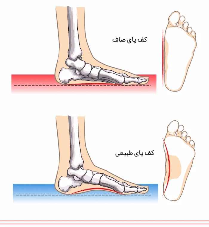 مقایسه کف پای صاف و طبیعی 961841635
