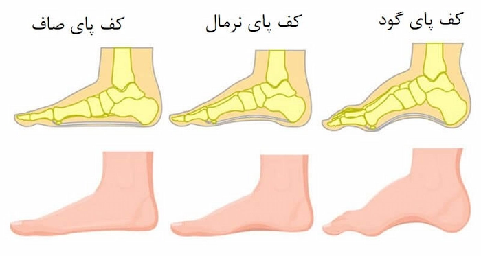 معرفی انواع فرم پا 4857498