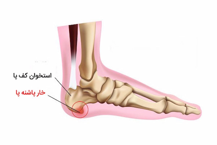 خار پاشنه پا 41584185