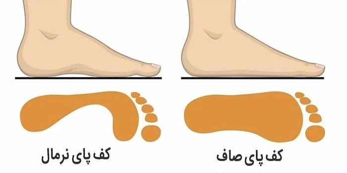 مقایسه کف پای صاف و طبیعی 49684
