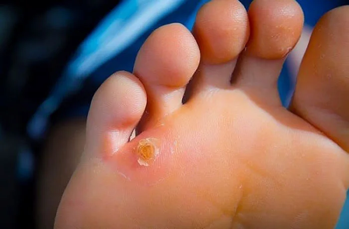 میخچه کف پا 54574651
